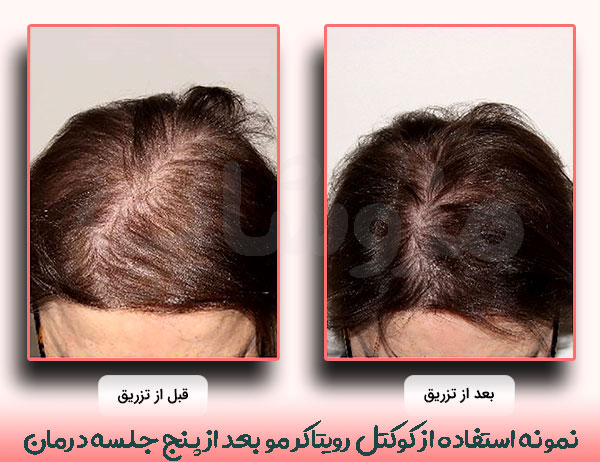 نمونه استفاده از کوکتل رویتاکر مو بعد از پنج جلسه درمان 
